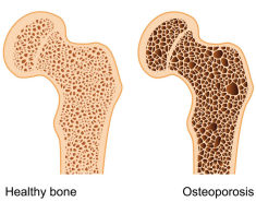 bone density